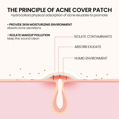 240 pieces of multi-color star acne patches, facial acne patches, concealer acne patches, and pimples patches, ultra-thin